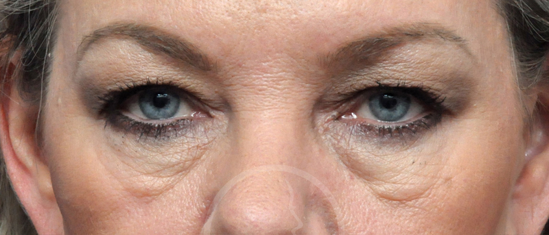 Blepharoplasty Before and After Pictures Jacksonville, FL