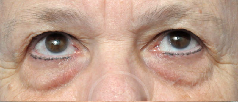 Blepharoplasty Before and After Pictures Jacksonville, FL