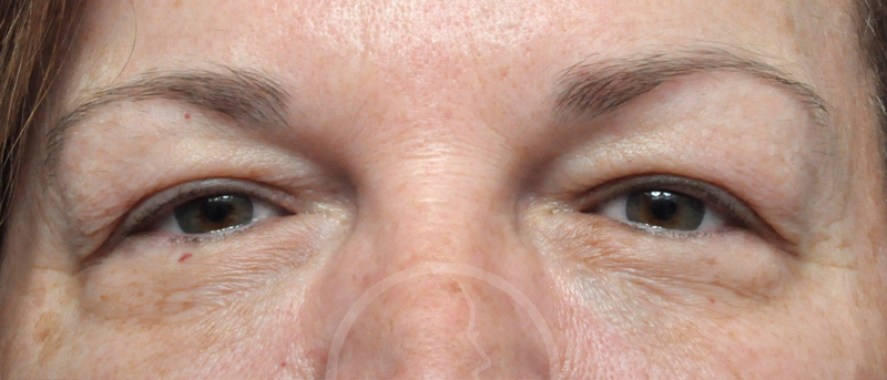 Blepharoplasty Before and After Pictures Jacksonville, FL