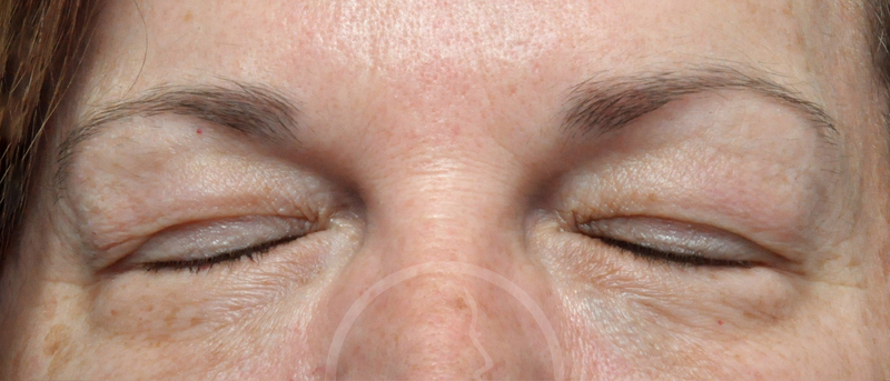 Blepharoplasty Before and After Pictures Jacksonville, FL