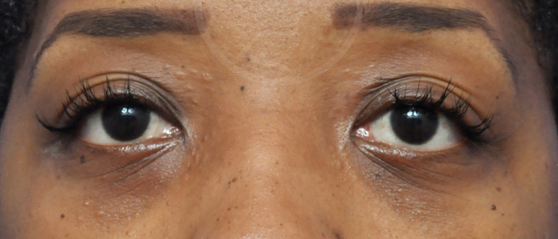 Blepharoplasty Before and After Pictures Jacksonville, FL