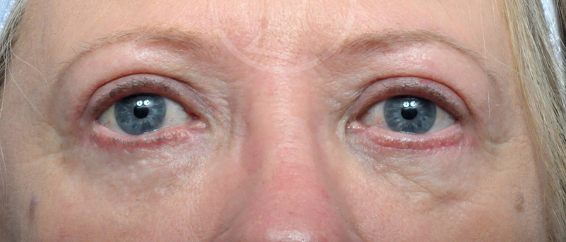 Blepharoplasty Before and After Pictures Jacksonville, FL