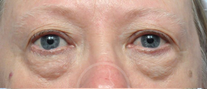 Blepharoplasty Before and After Pictures Jacksonville, FL