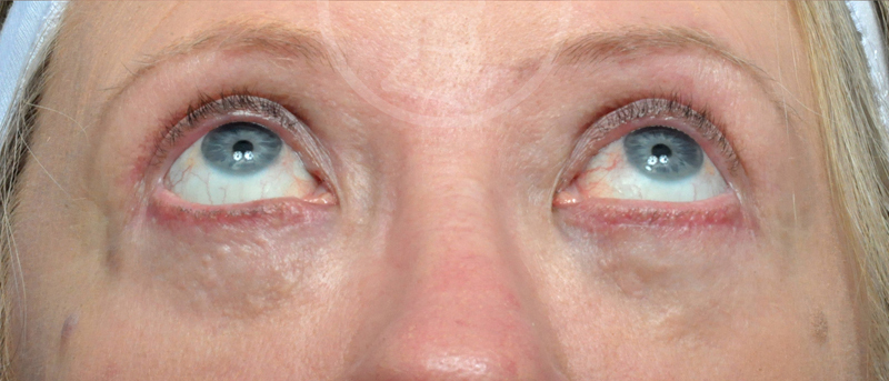 Blepharoplasty Before and After Pictures Jacksonville, FL