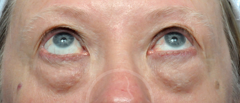 Blepharoplasty Before and After Pictures Jacksonville, FL