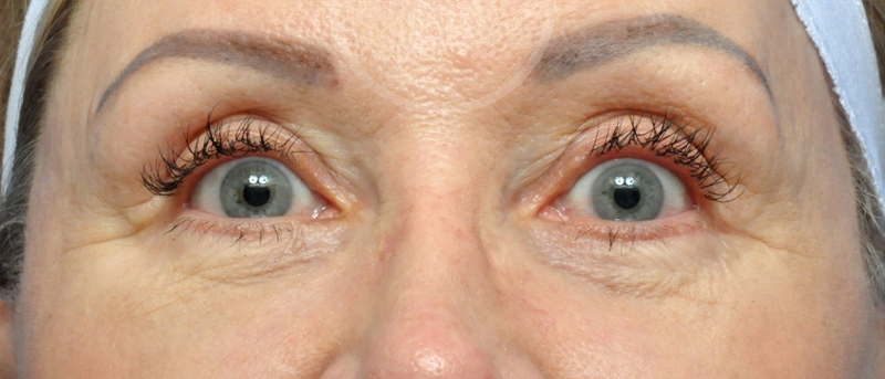 Blepharoplasty Before and After Pictures Jacksonville, FL