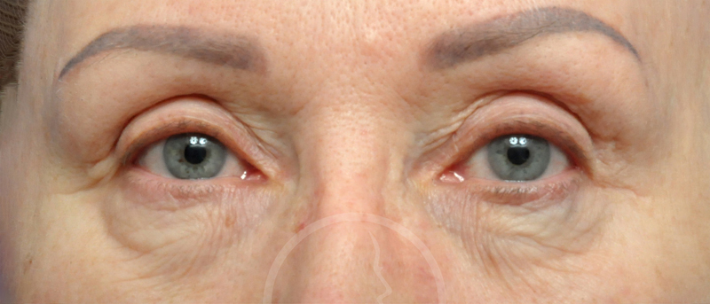 Blepharoplasty Before and After Pictures Jacksonville, FL