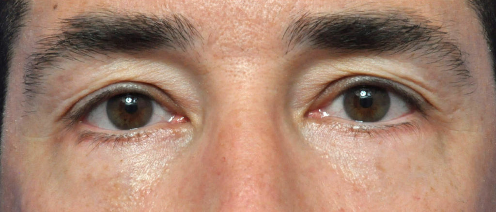 Blepharoplasty Before and After Pictures Jacksonville, FL