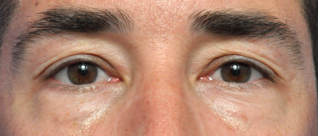 Blepharoplasty Before and After Pictures Jacksonville, FL