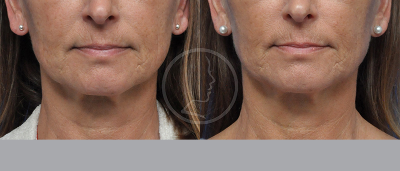 Blepharoplasty Before and After Pictures Jacksonville, FL