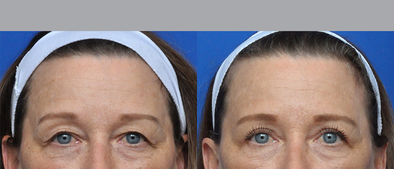 Blepharoplasty Before and After Pictures Jacksonville, FL