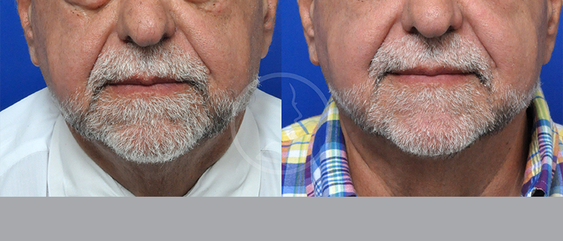 Blepharoplasty Before and After Pictures Jacksonville, FL