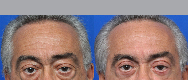 Blepharoplasty Before and After Pictures Jacksonville, FL