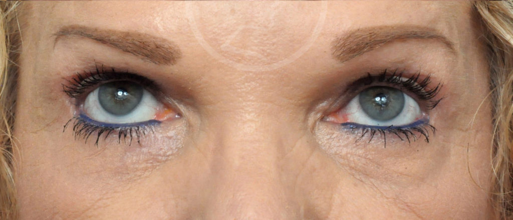 Blepharoplasty Before and After Pictures Jacksonville, FL