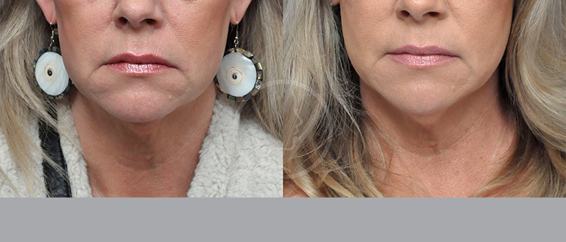 Blepharoplasty Before and After Pictures Jacksonville, FL