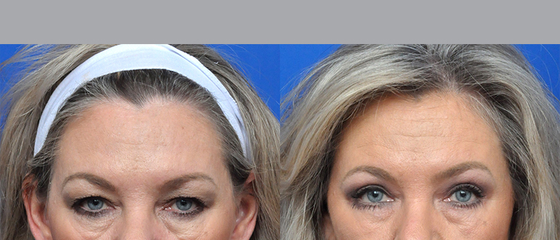 Blepharoplasty Before and After Pictures Jacksonville, FL