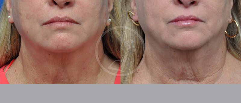 Blepharoplasty Before and After Pictures Jacksonville, FL