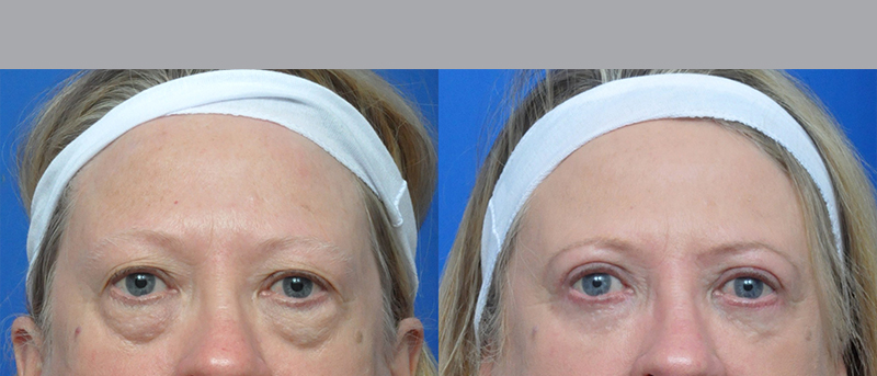 Blepharoplasty Before and After Pictures Jacksonville, FL