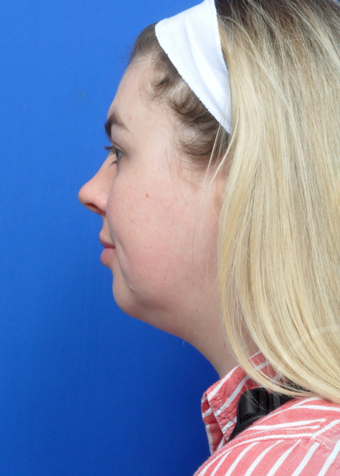 Neck Liposuction Before and After Pictures Jacksonville, FL