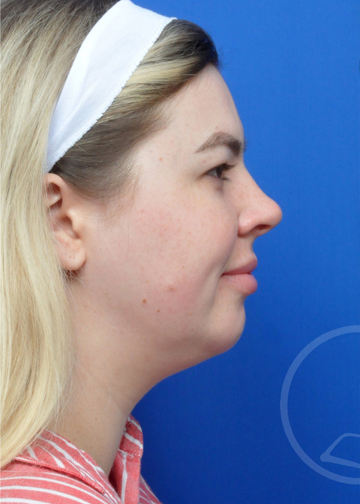 Neck Liposuction Before and After Pictures Jacksonville, FL