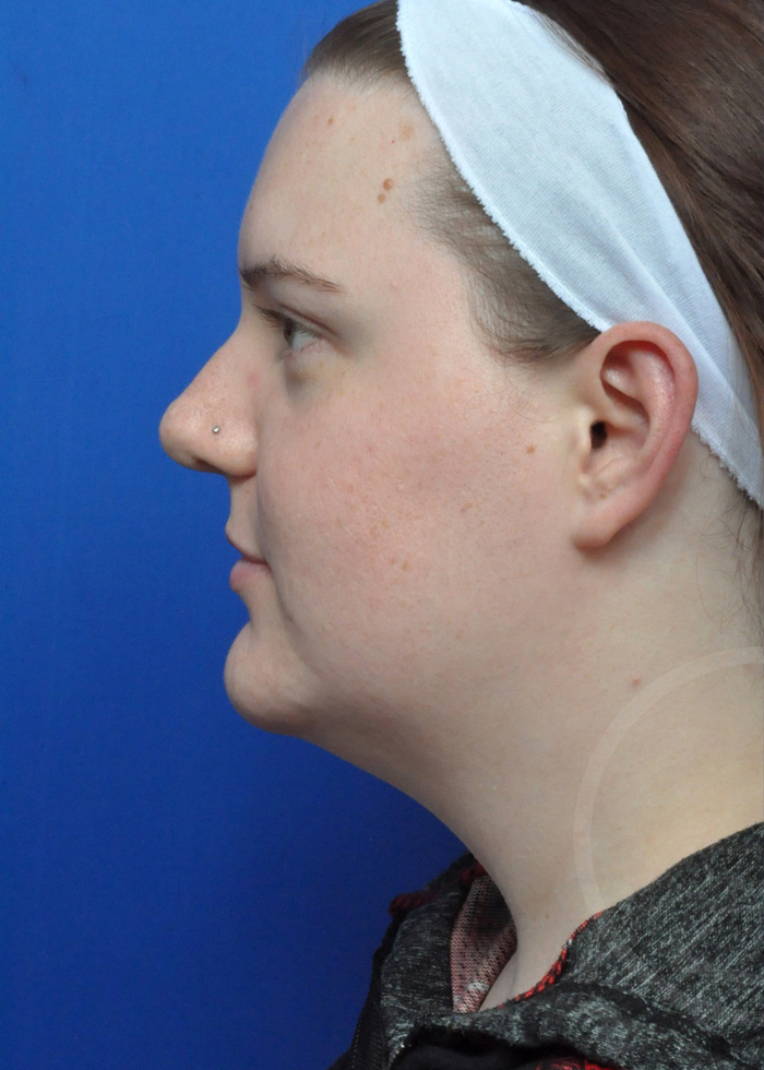 Neck Liposuction Before and After Pictures Jacksonville, FL