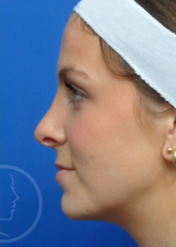 Rhinoplasty Before and After Pictures Jacksonville, FL