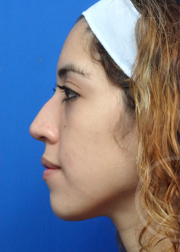 Rhinoplasty Before and After Pictures Jacksonville, FL