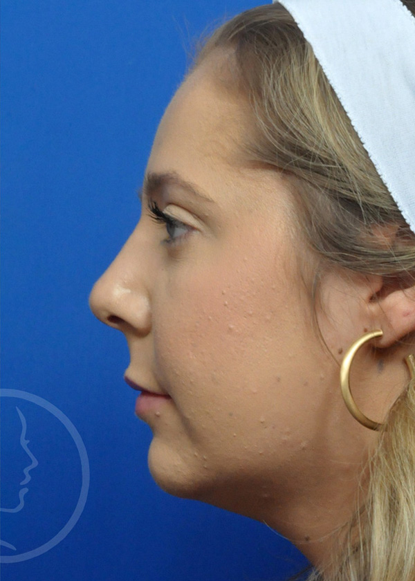 Rhinoplasty Before and After Pictures Jacksonville, FL