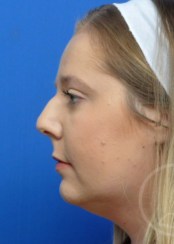 Rhinoplasty Before and After Pictures Jacksonville, FL