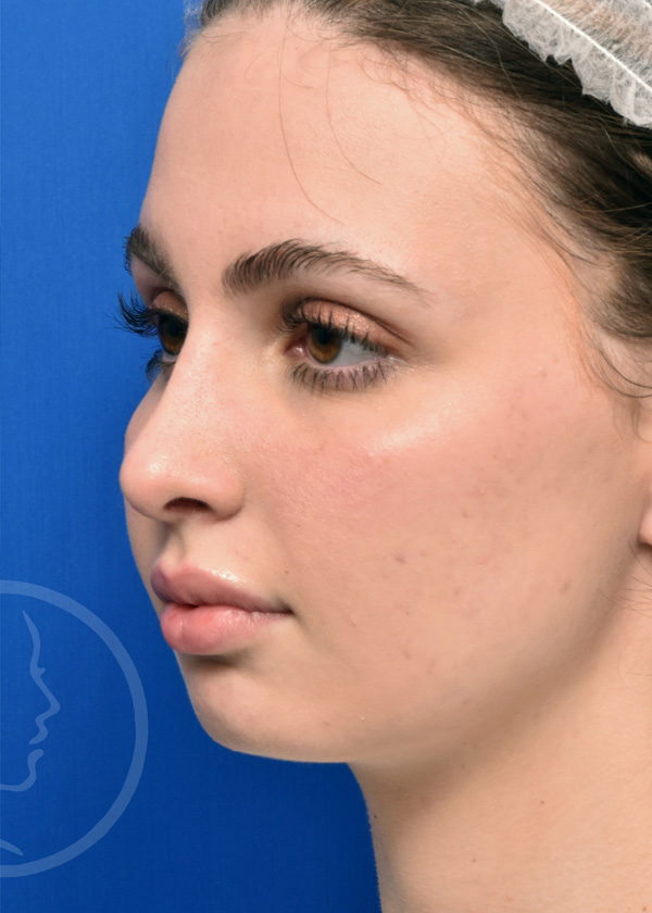 Rhinoplasty Before and After Pictures Jacksonville, FL