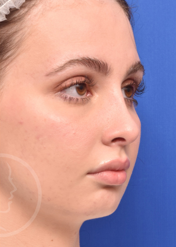 Rhinoplasty Before and After Pictures Jacksonville, FL