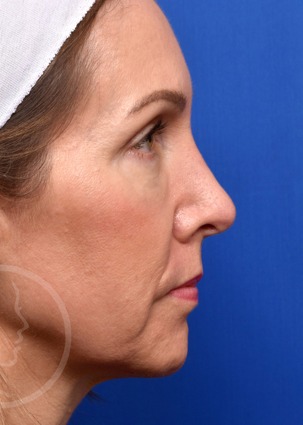 Rhinoplasty Before and After Pictures Jacksonville, FL