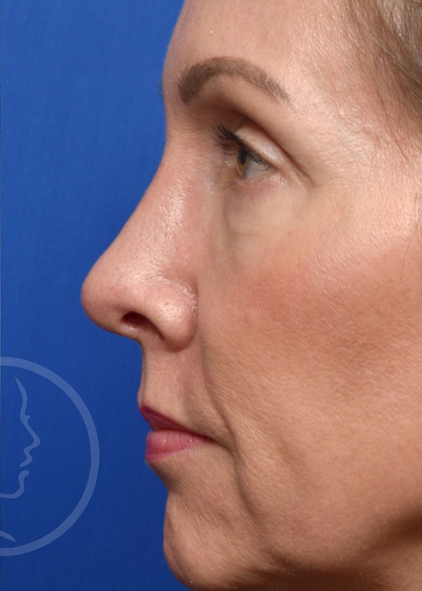 Rhinoplasty Before and After Pictures Jacksonville, FL