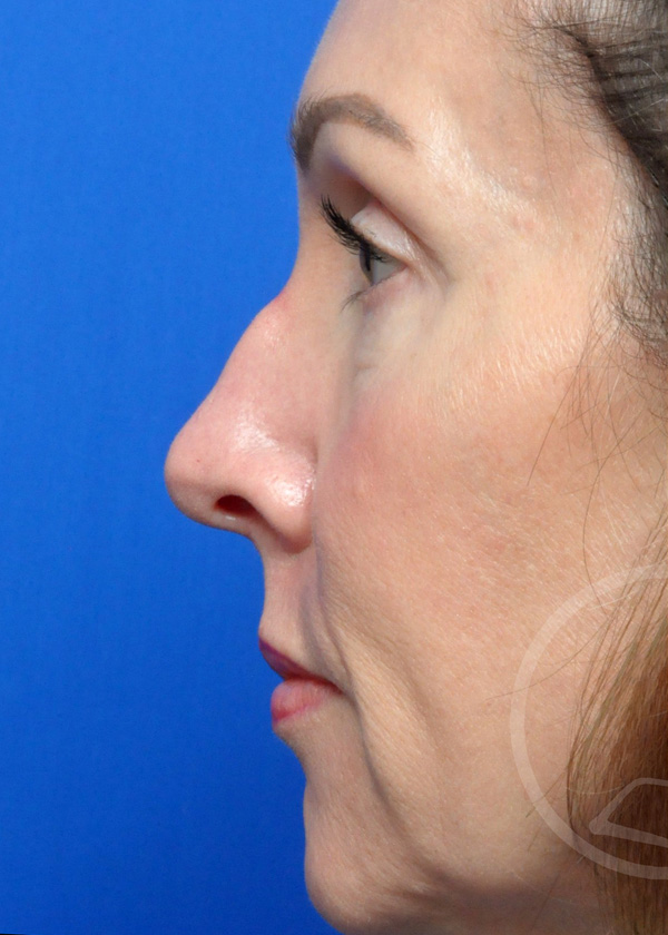 Rhinoplasty Before and After Pictures Jacksonville, FL