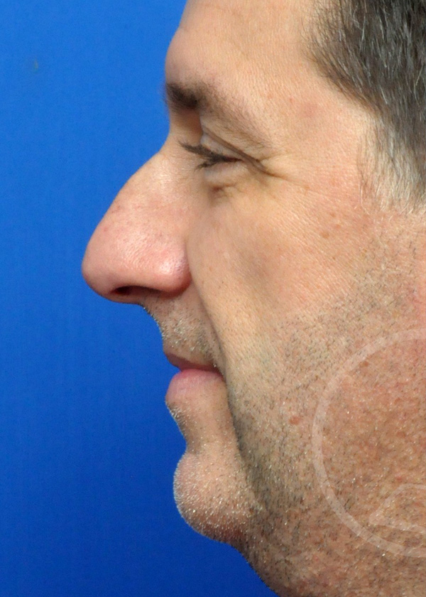 Rhinoplasty Before and After Pictures Jacksonville, FL