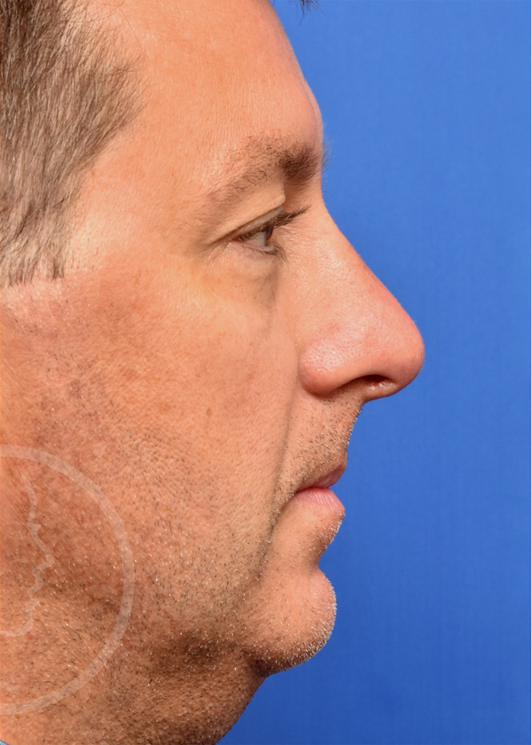 Rhinoplasty Before and After Pictures Jacksonville, FL