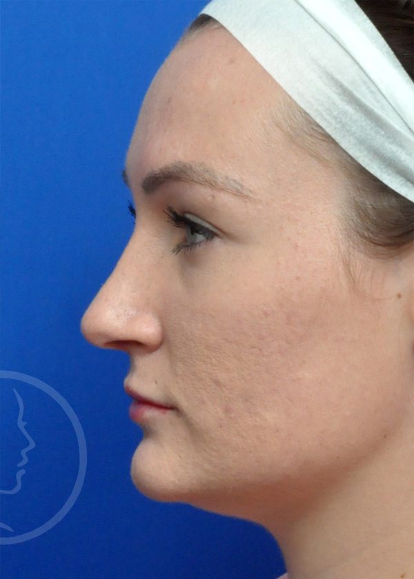 Rhinoplasty Before and After Pictures Jacksonville, FL