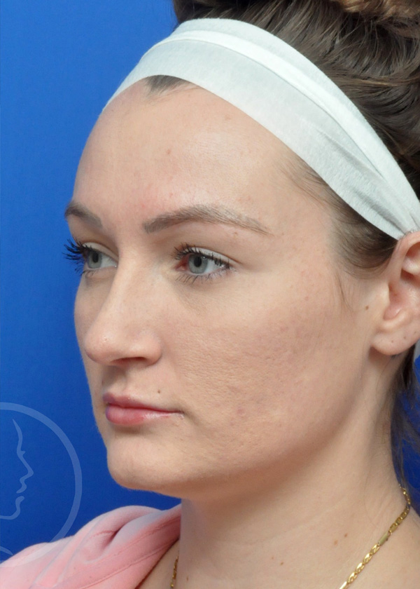 Rhinoplasty Before and After Pictures Jacksonville, FL