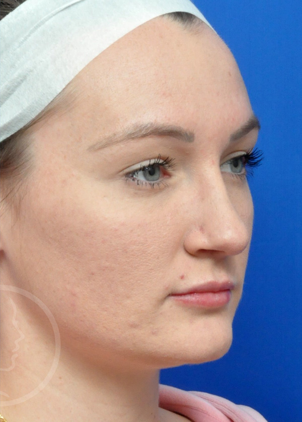 Rhinoplasty Before and After Pictures Jacksonville, FL