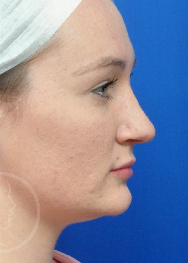 Rhinoplasty Before and After Pictures Jacksonville, FL