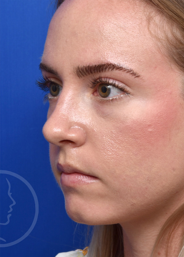 Rhinoplasty Before and After Pictures Jacksonville, FL