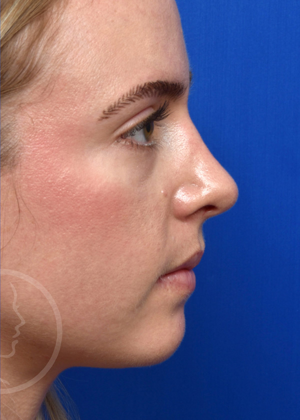 Rhinoplasty Before and After Pictures Jacksonville, FL