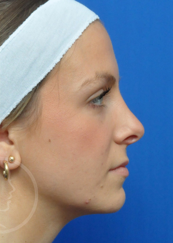 Rhinoplasty Before and After Pictures Jacksonville, FL