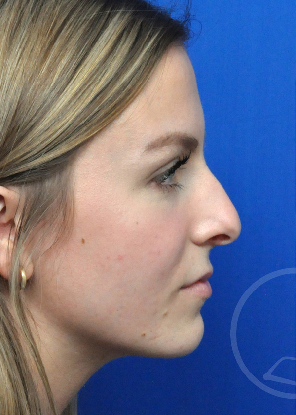 Rhinoplasty Before and After Pictures Jacksonville, FL