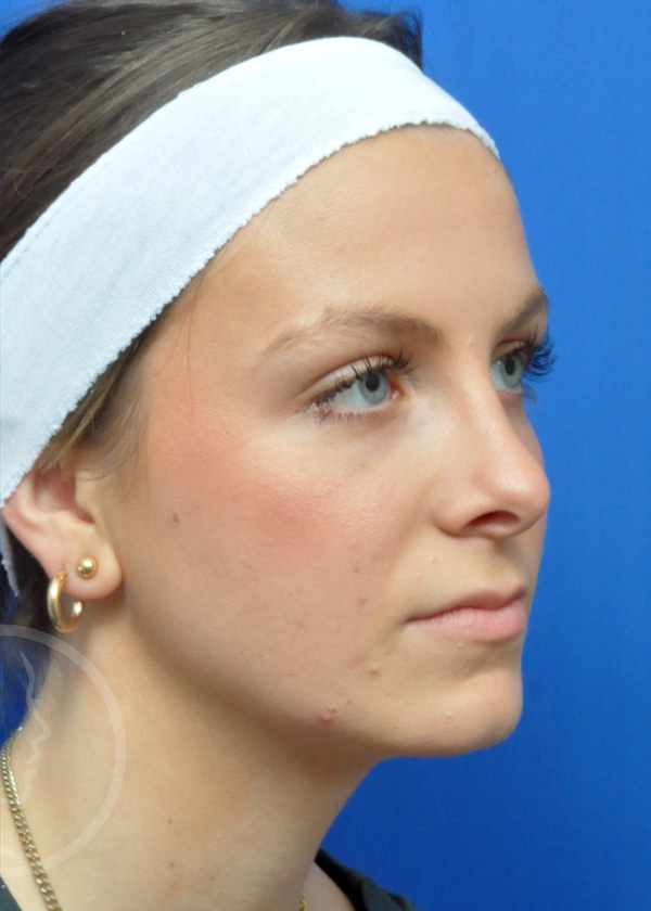 Rhinoplasty Before and After Pictures Jacksonville, FL