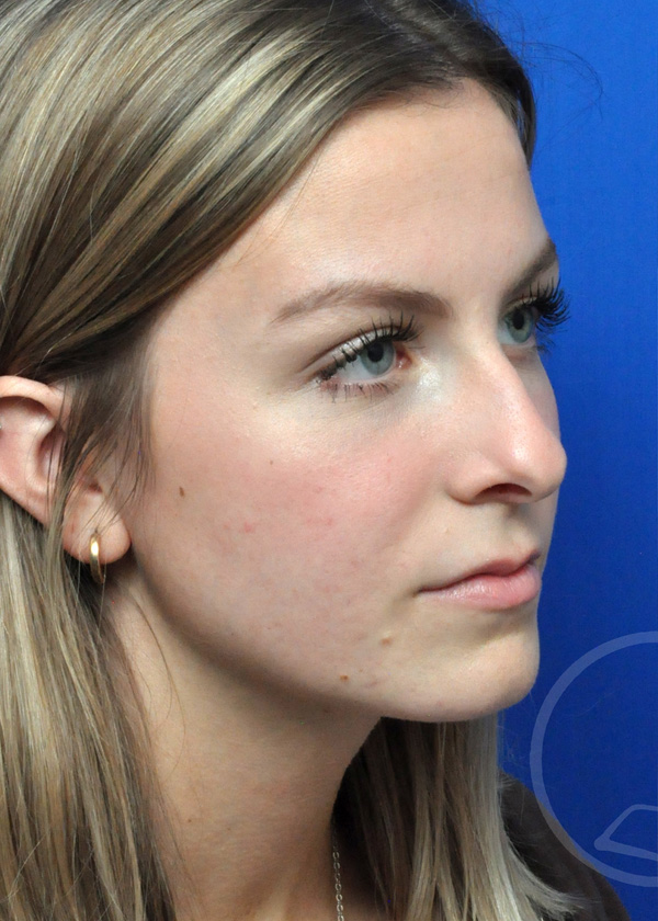 Rhinoplasty Before and After Pictures Jacksonville, FL