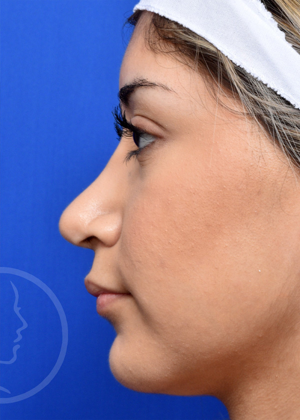 Rhinoplasty Before and After Pictures Jacksonville, FL