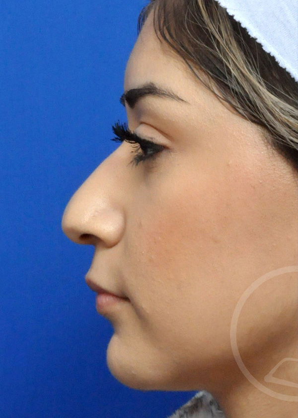 Rhinoplasty Before and After Pictures Jacksonville, FL