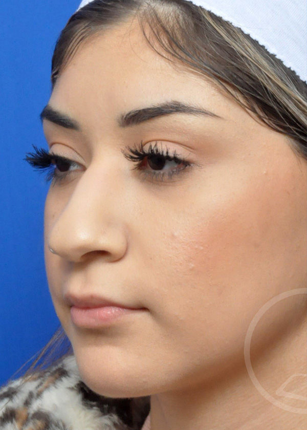 Rhinoplasty Before and After Pictures Jacksonville, FL