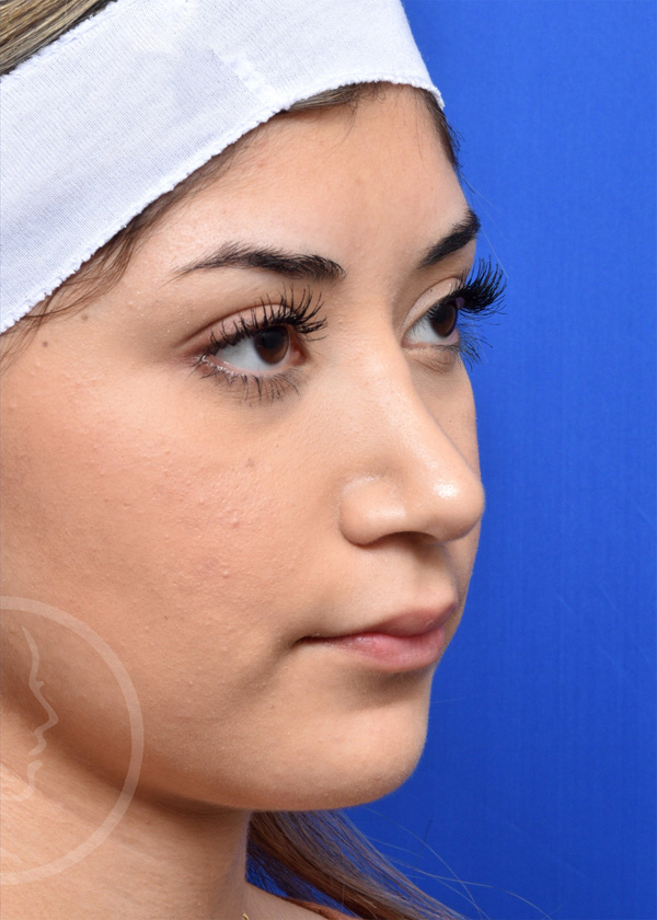 Rhinoplasty Before and After Pictures Jacksonville, FL